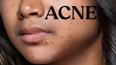 Menopause Acne - Causes, Prevention and Treatment ( Acne After 40s )
